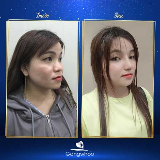 Nâng Mũi Có Thay Đổi Khuôn Mặt Không?