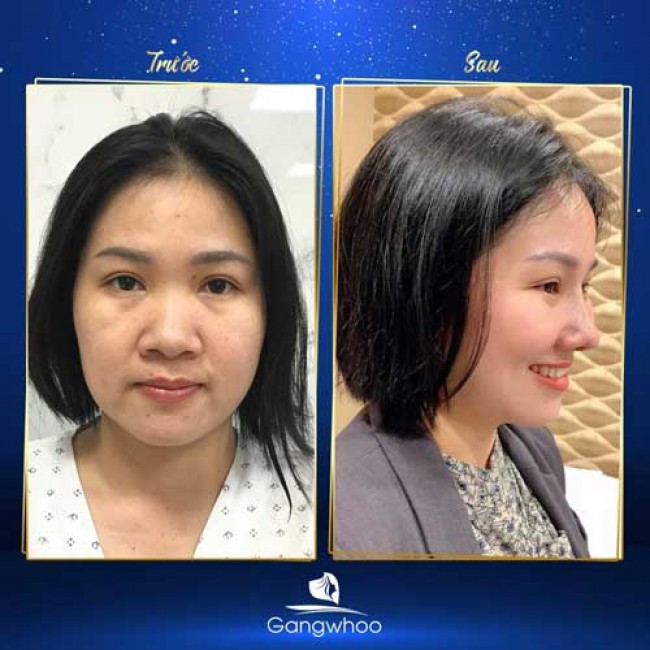 Nâng Mũi Có Thay Đổi Khuôn Mặt Không?