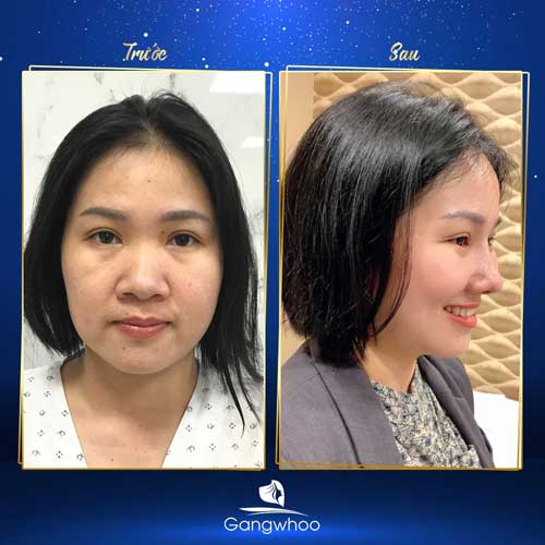 Nâng Mũi Có Thay Đổi Khuôn Mặt Không?