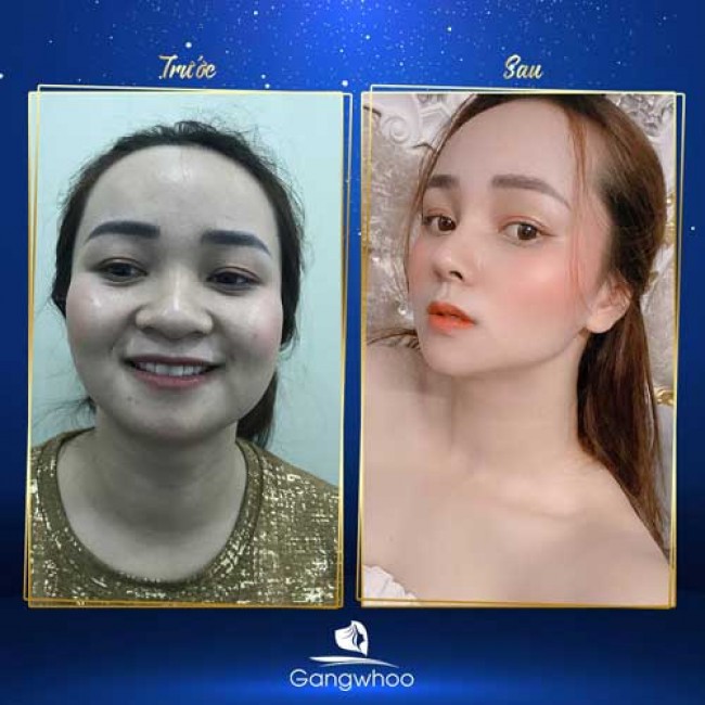 Nâng Mũi Có Thay Đổi Khuôn Mặt Không?