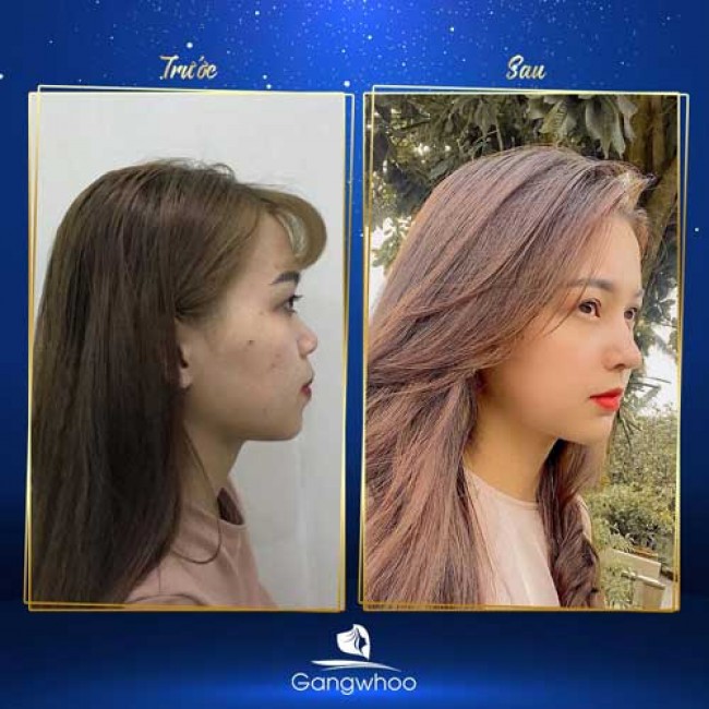 Nâng Mũi Có Thay Đổi Khuôn Mặt Không?