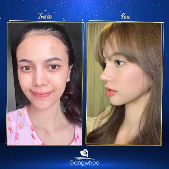 Nâng Mũi Có Thay Đổi Khuôn Mặt Không?