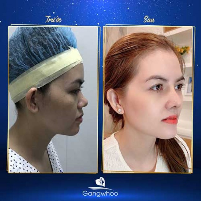 Nâng Mũi Có Thay Đổi Khuôn Mặt Không?