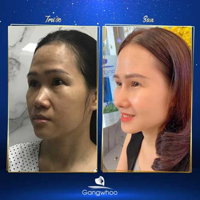 Nâng Mũi Có Thay Đổi Khuôn Mặt Không?