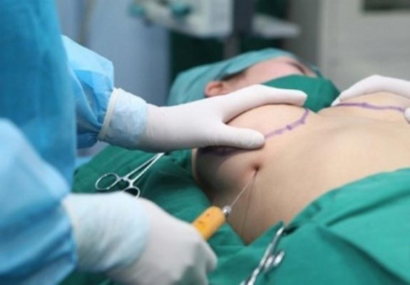 Nâng cấp vòng 1 – Những điều cần biết