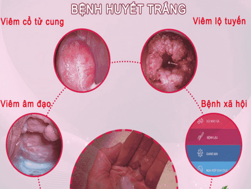Có nhiều nguyên nhân dẫn đến tình trạng  huyết trắng bệnh lý.