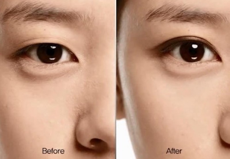 5 điều cần biết trước trước khi đi nhấn mí