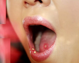 Bài thuốc trị nhiệt miệng từ thảo dược