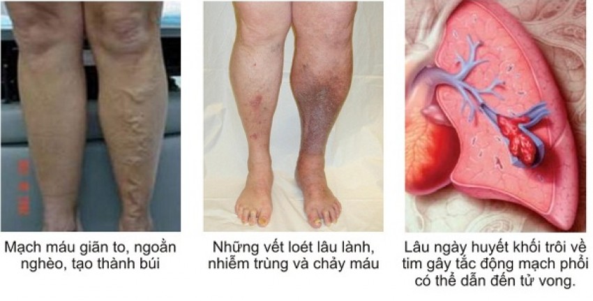 Những dấu hiệu nhận biết viêm tắc động mạch.