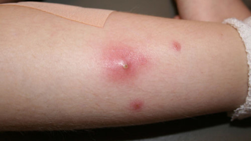 7 mẹo trị nhọt cực hiệu quả và dễ làm