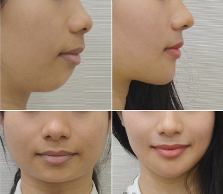 cằm lẹm với nữ