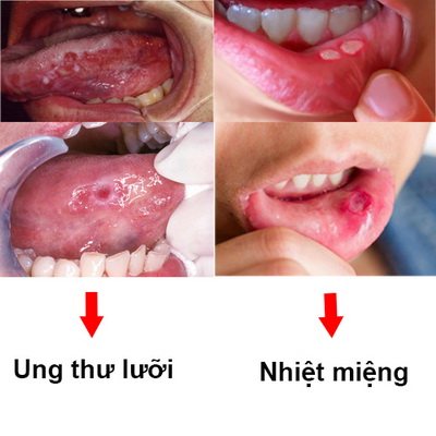 Phân biệt nhiệt miệng và ung thư lưỡi