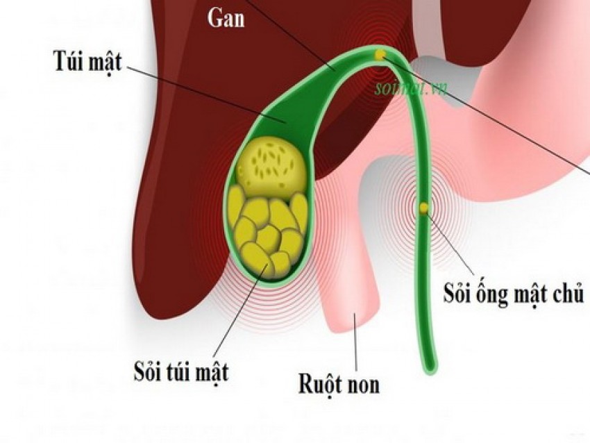 Hình ảnh sỏi mật.