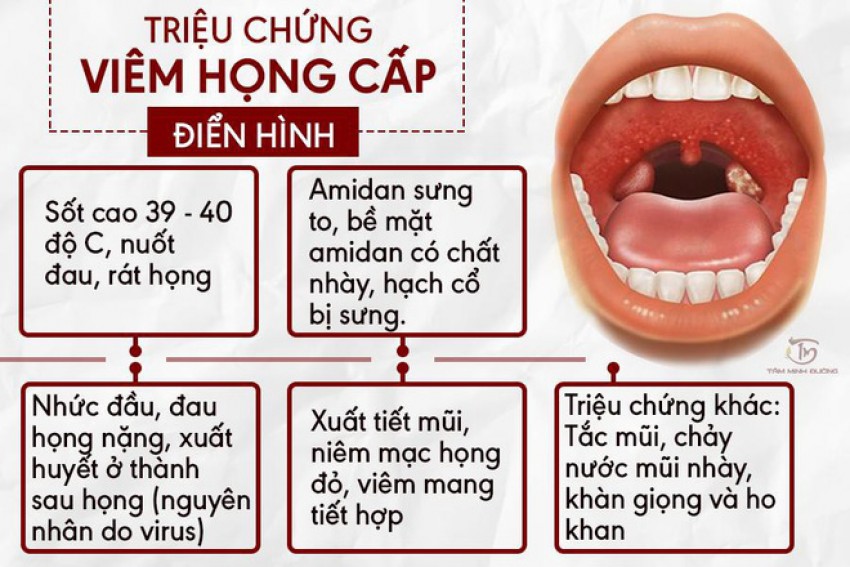 Trời lạnh, coi chừng viêm họng phát tác