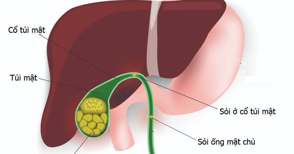 Nhận diện và xử trí kịp thời sỏi túi mật