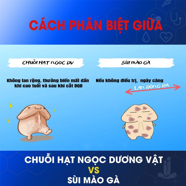 Mất 32 triệu đồng chữa "chuỗi hạt ngọc" dương vật vẫn không khỏi