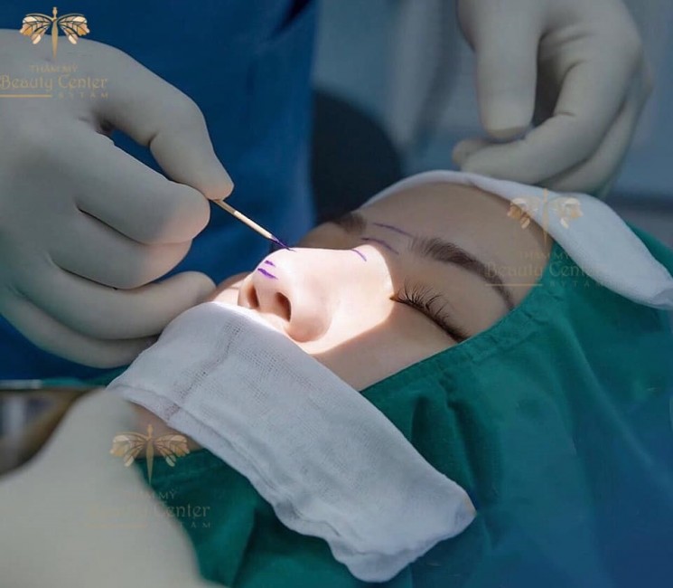 nâng mũi sline hàn quốc