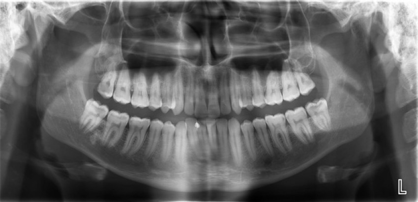 Răng khôn mọc lệch