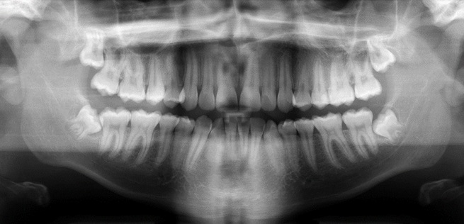 Răng khôn mọc lệch, ngầm: Nhổ hay không nhổ?