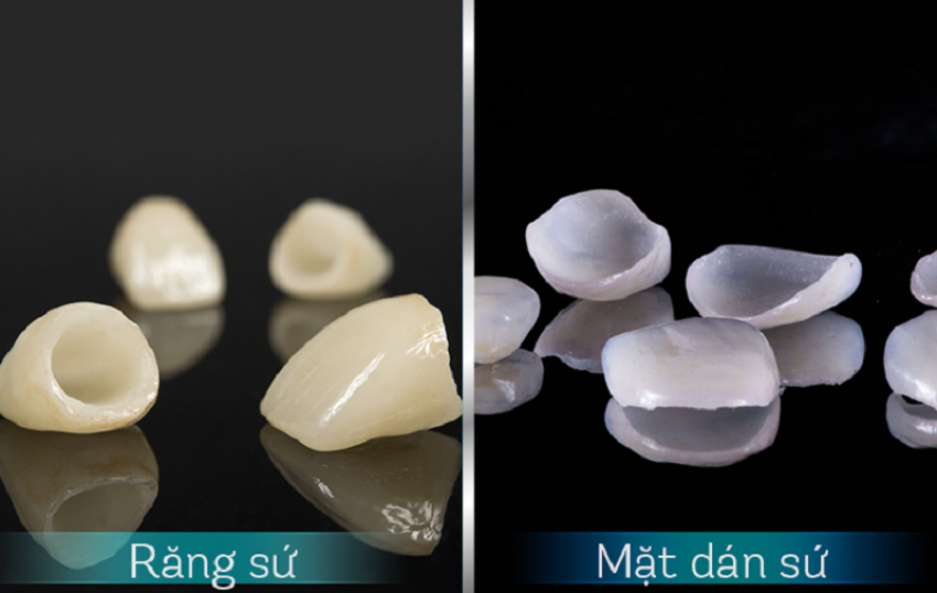 so sánh dán veneer và bọc sứ
