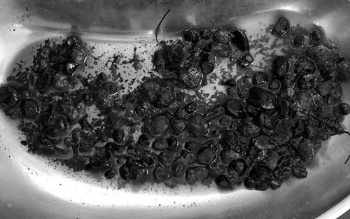 Bệnh lý sỏi gan có nguy hiểm?