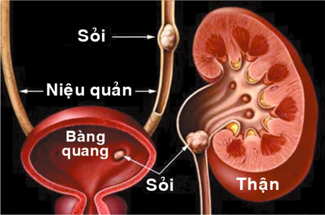 Phòng trị sỏi tiết niệu bằng rau, củ