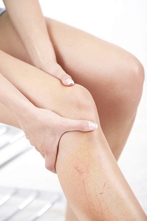 Dịch COVID-19, bệnh nhân suy tĩnh mạch mạn tính cần lưu ý gì?