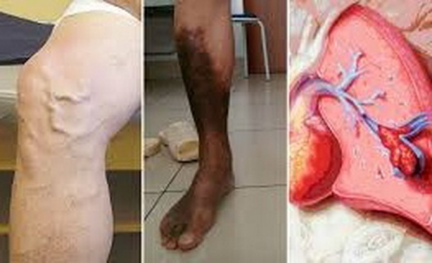 Hình ảnh tắc động mạch chi dưới.