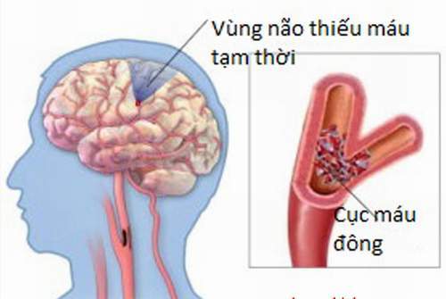 Chớ xem thường thiếu máu não cục bộ tạm thời