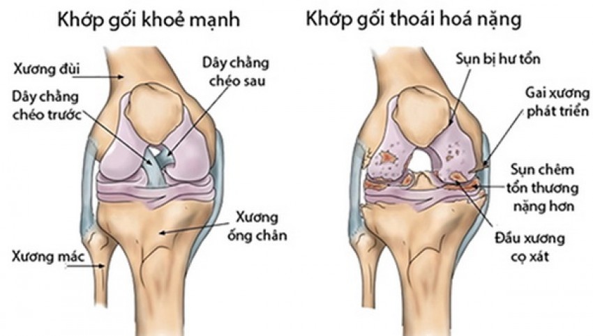Thoái hóa khớp thường gây đau nhức, đi lại khó khăn...