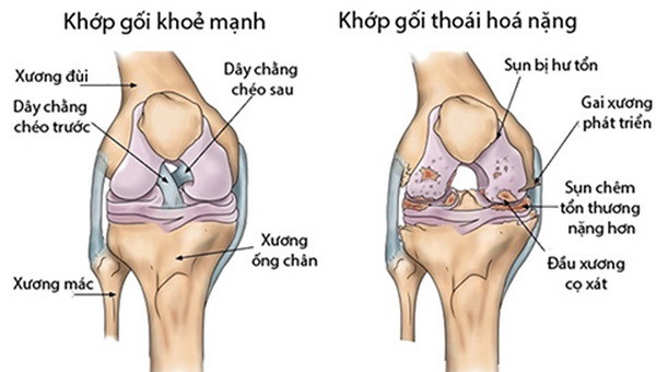 9 yếu tố dễ gây thoái hóa khớp