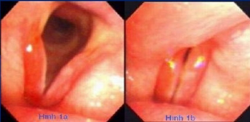 Hình ảnh viêm thanh quản cấp qua nội soi.