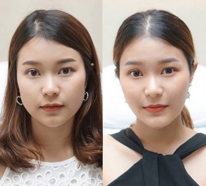 botox gọn hàm