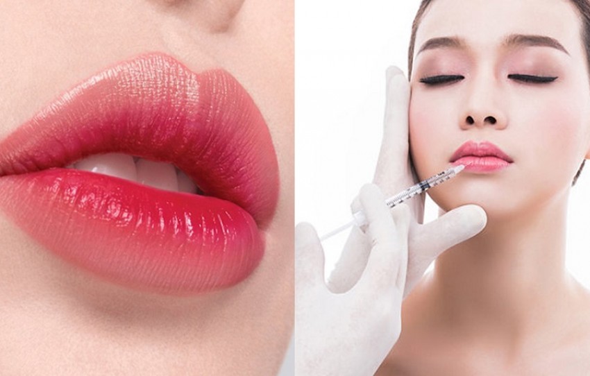 cắt xong tiêm filler được không