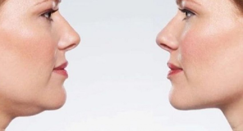 tiêm giảm mỡ nọng cằm có hiệu quả không
