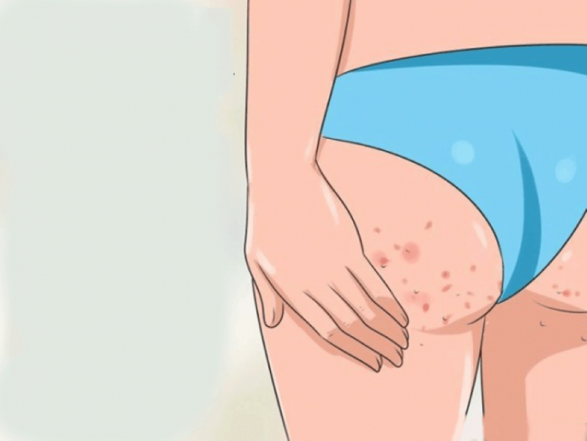 trị mụn ở mông