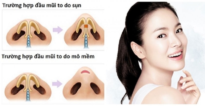 các thủ thuật thu nhỏ đầu mũi
