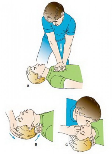 Các bước chính trong hồi sức tim phổi.