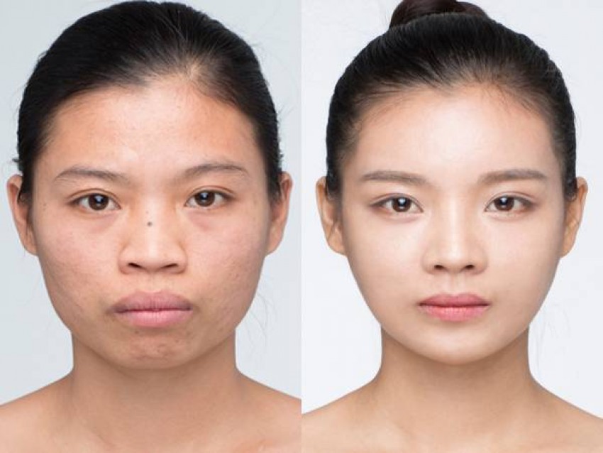 Cằm Lẹm Là Cằm Thế Nào? Có Khắc Phục Được Không?