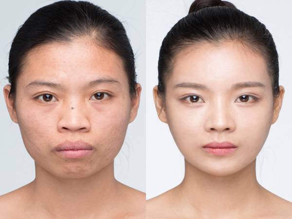 Cằm Lẹm Là Cằm Thế Nào? Có Khắc Phục Được Không?
