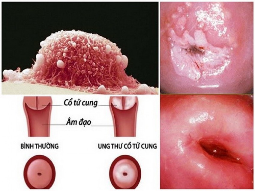 Hình ảnh ung thư cổ tử cung.