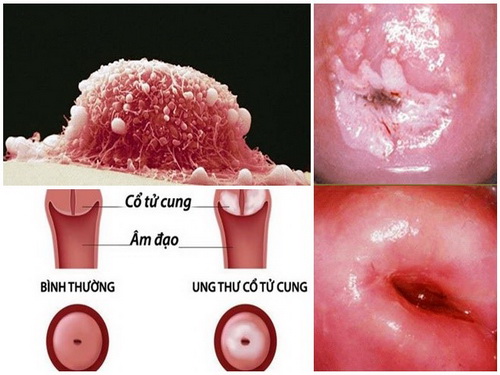Lây nhiễm HPV và nguy cơ ung thư cổ tử cung