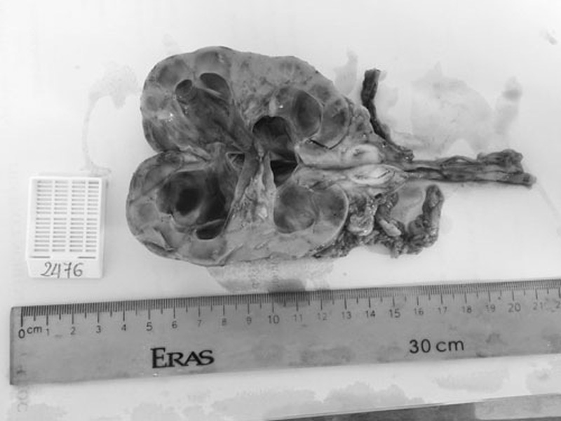 Đái ra máu- Cẩn thận bệnh nguy hiểm!