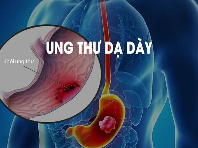 Ung thư dạ dày ngày càng gia tăng