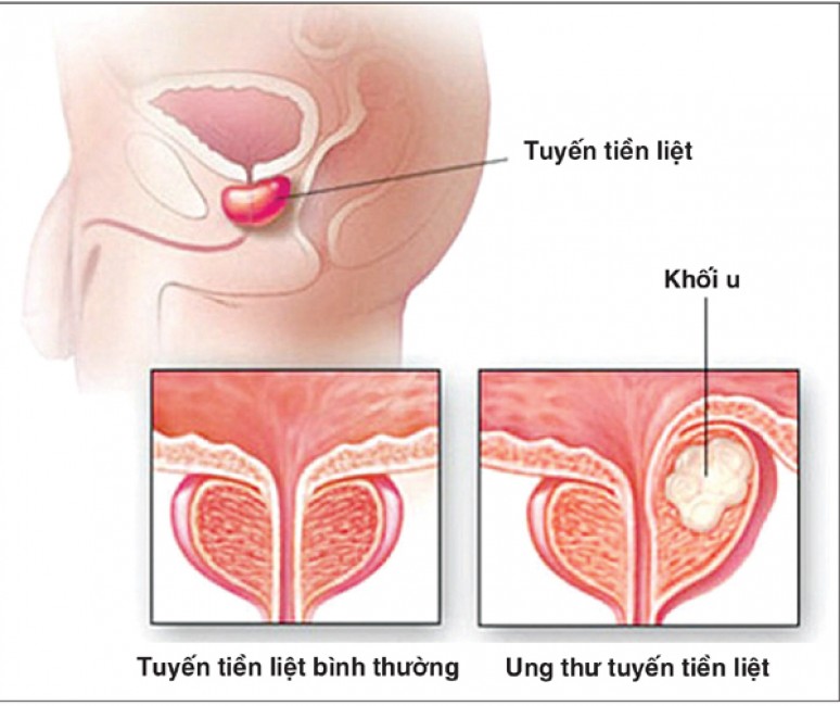Ung thư tiền liệt tuyến có thễ chữa lành?