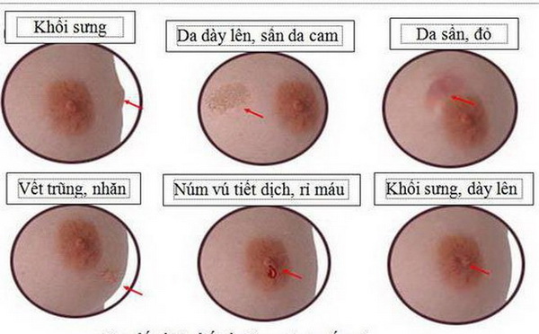 Cách tự kiểm tra phát hiện ung thư vú