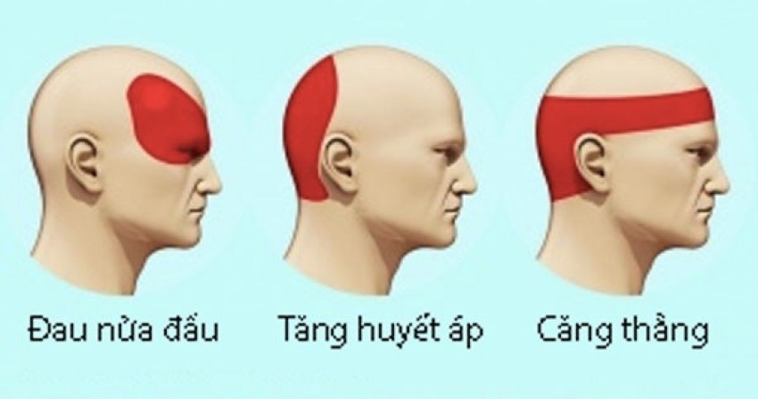 Các vùng ảnh hưởng từ đau đầu do tăng huyết áp, stress, đau nửa đầu.