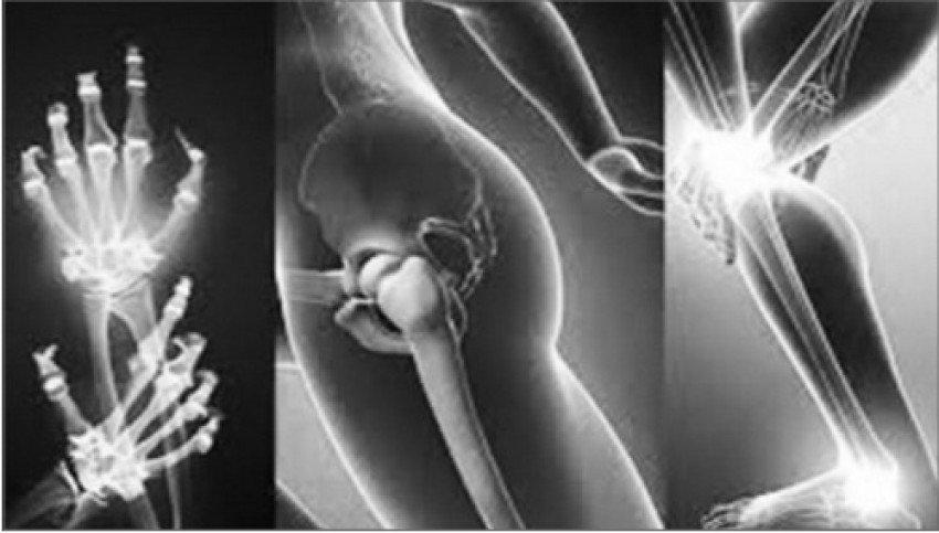 Bệnh cơ xương khớp thường gây trở ngại hoạt động tình dục.