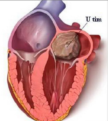 U trong tim, bệnh khó phòng ngừa