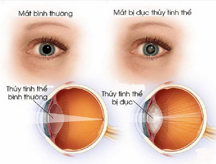 Đục thủy tinh thể - một nguyên nhân gây mờ mắt.
